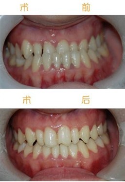 牙齒反頜矯正