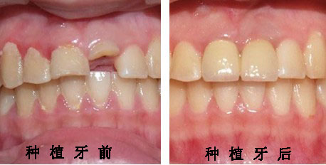 缺牙后為什么要及時(shí)修復(fù)？