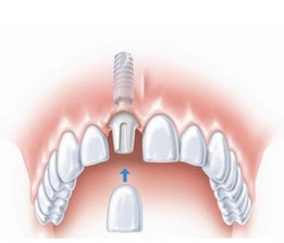 韓國Dentium種植