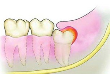 智齒冠周炎的表現(xiàn)和治療方法！