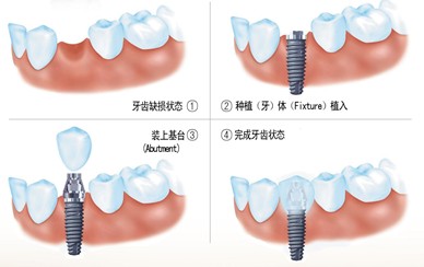 種植牙的優(yōu)點
