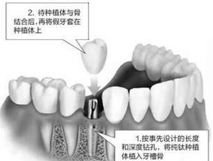 人工種植牙的價(jià)格