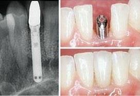 牙內(nèi)骨內(nèi)種植體！