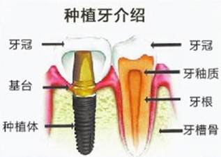 瑞典NOBEL種植牙系統(tǒng)優(yōu)勢