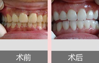 美白牙齒哪種方法較有效、較安全