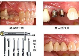 【客戶案例】牙齒缺損，即刻種植牙解除他的煩惱