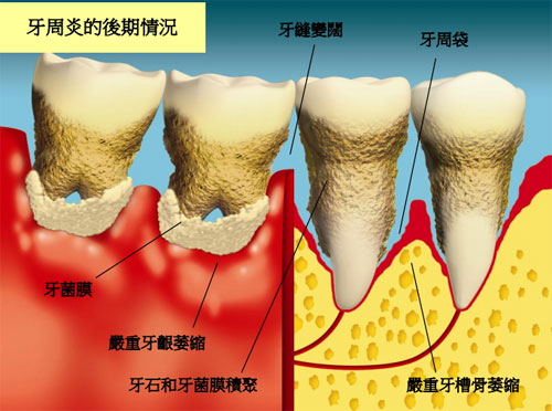 什么原因會(huì)引致劇烈牙痛？