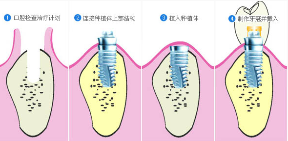 種植牙該如何護(hù)理呢？有什么需要注意的呢?