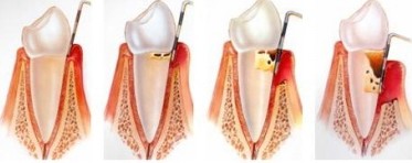 牙周炎的7個(gè)典型癥狀？