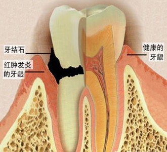 牙齦炎平時(shí)怎么處理！