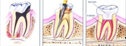 根管治療和補牙的區(qū)別