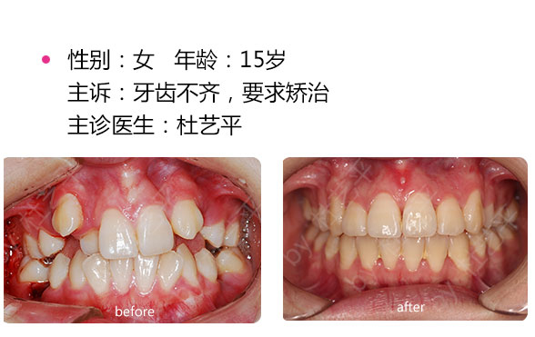 深圳哪些因素影響地包天矯正手術(shù)的價格