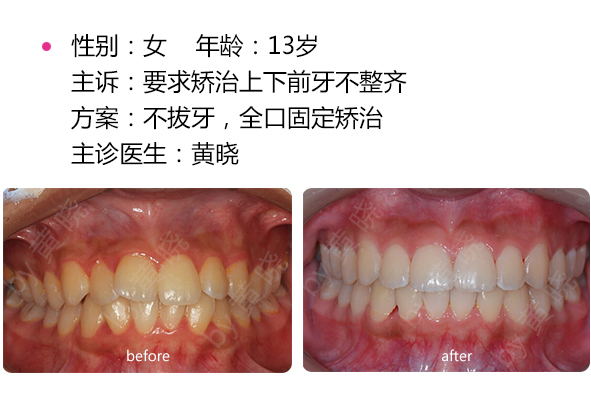 深圳牙齒矯正手術(shù)價格