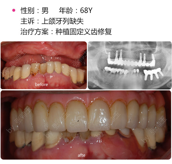 種植后牙選擇什么材料好