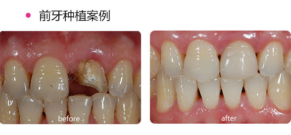 種植牙與傳統(tǒng)假牙比具有哪些優(yōu)勢(shì)