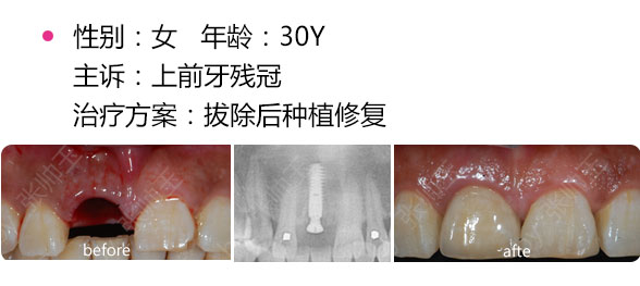 拔牙后可以馬上種牙嗎？