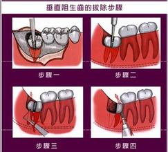 深圳拔智齒多少錢一顆？