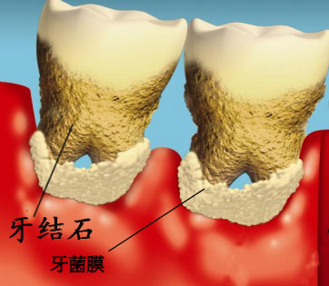 牙結(jié)石相關(guān)知識(shí)解答