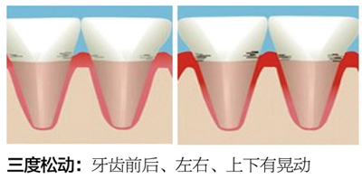 牙齒松動(dòng)怎么治療？