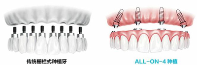 all-on-4種植是怎樣種牙的？