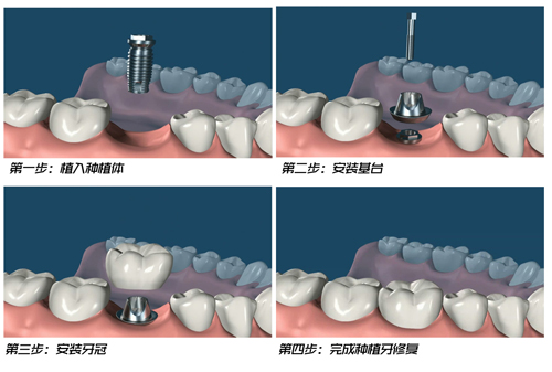 缺牙后何時種牙比較好？