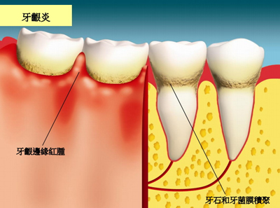 牙齦炎是怎么引起的？