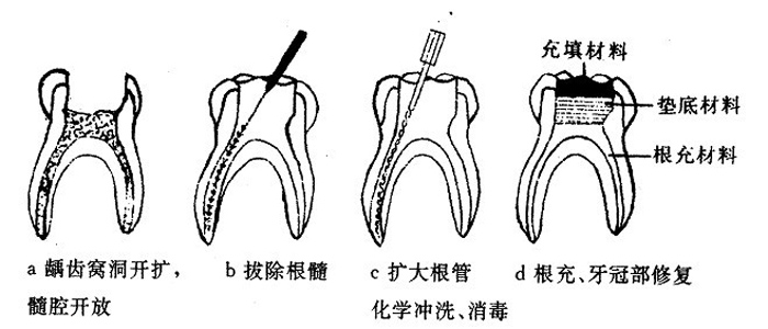 根管治療后為什么還要做牙冠？