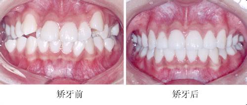 深圳牙齒矯正需要多長時間？