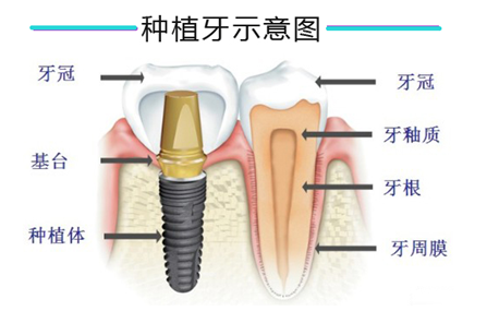 種植牙如何延長使用壽命？