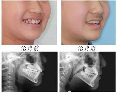 兒童牙齒不齊有什么影響？