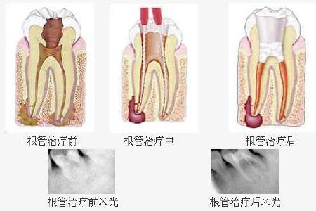 什么情況下需要做根管治療？