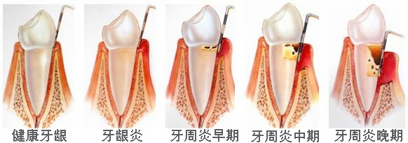 牙周病到底是如何形成的？