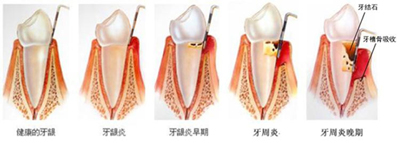 牙齦炎會導(dǎo)致哪些并發(fā)癥？