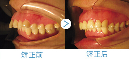 齙牙的危害有哪些？