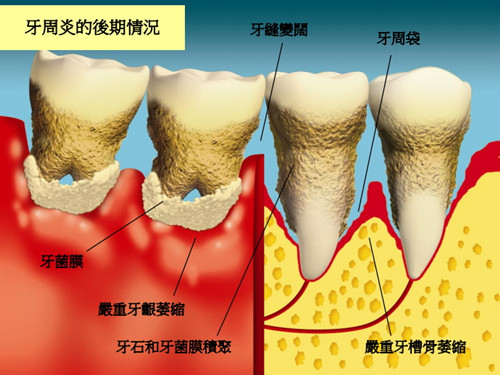 牙周炎有哪些危害？