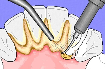 3個(gè)方法教你去除牙結(jié)石