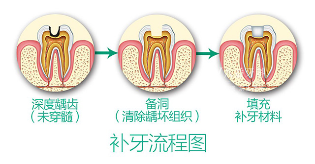 補(bǔ)牙的手術(shù)過程要多久？