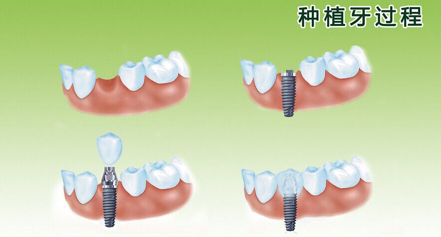 種植牙要避免這些誤區(qū)
