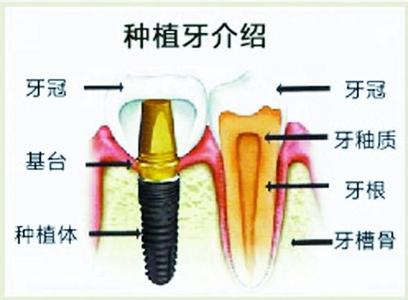 如何正確保養(yǎng)種植牙？