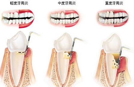 哪些方法可以預(yù)防牙周炎？