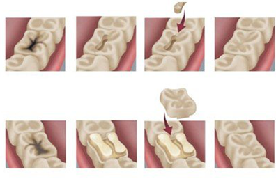 蛀牙補牙用什么材料比較好？