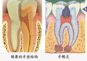 導(dǎo)致急性牙髓炎的原因有哪些？