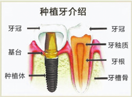 種植體脫落怎么辦？