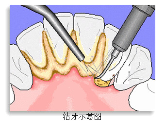 洗牙前要注意哪些事項？