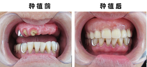 半口牙缺失做種植牙時(shí)間久嗎？