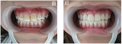氟斑牙怎么治療效果比較好？