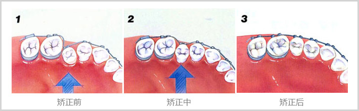 牙齒矯正有后遺癥嗎？