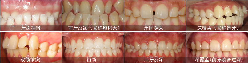 哪些人急需做牙齒矯正？