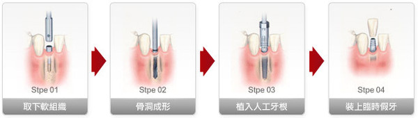 種植牙修復(fù)會(huì)不會(huì)很痛？