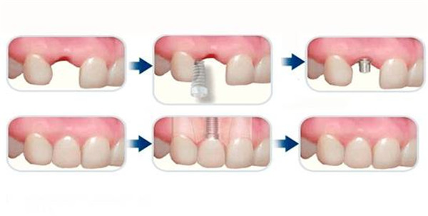 種植牙的周期是怎樣的？